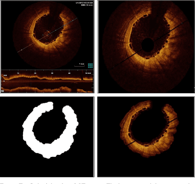 Figure 3 for Patient-Specific 3D Volumetric Reconstruction of Bioresorbable Stents: A Method to Generate 3D Geometries for Computational Analysis of Coronaries Treated with Bioresorbable Stents
