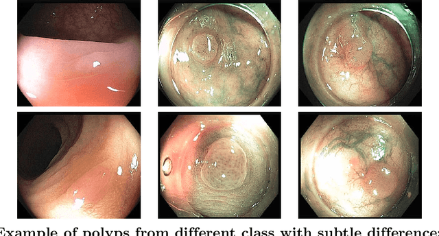 Figure 1 for A Comparative Study on Polyp Classification using Convolutional Neural Networks