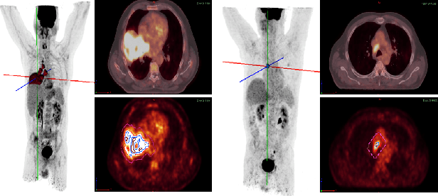 Figure 1 for Multi-Task Multi-Scale Learning For Outcome Prediction in 3D PET Images