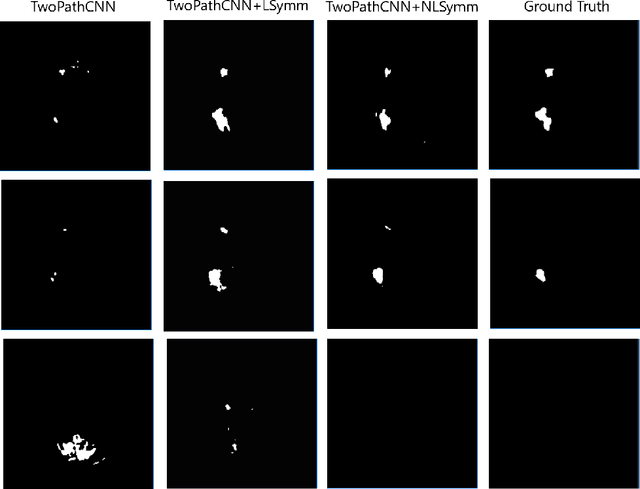 Figure 4 for Exploiting bilateral symmetry in brain lesion segmentation