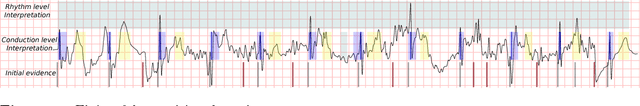 Figure 3 for Abductive reasoning as the basis to reproduce expert criteria in ECG Atrial Fibrillation identification