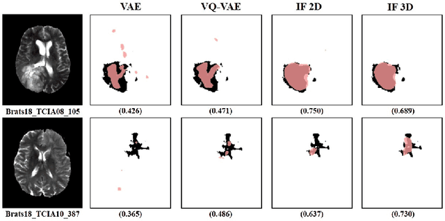 Figure 4 for Implicit field learning for unsupervised anomaly detection in medical images