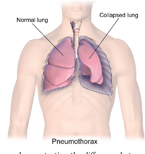 Figure 1 for Do it Like the Doctor: How We Can Design a Model That Uses Domain Knowledge to Diagnose Pneumothorax