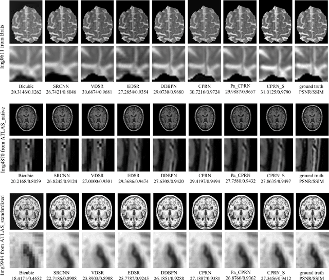 Figure 4 for Coupled-Projection Residual Network for MRI Super-Resolution
