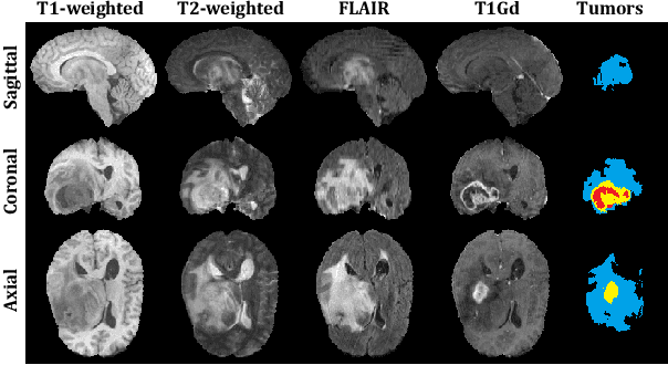 Figure 1 for Neural Architecture Search for Gliomas Segmentation on Multimodal Magnetic Resonance Imaging
