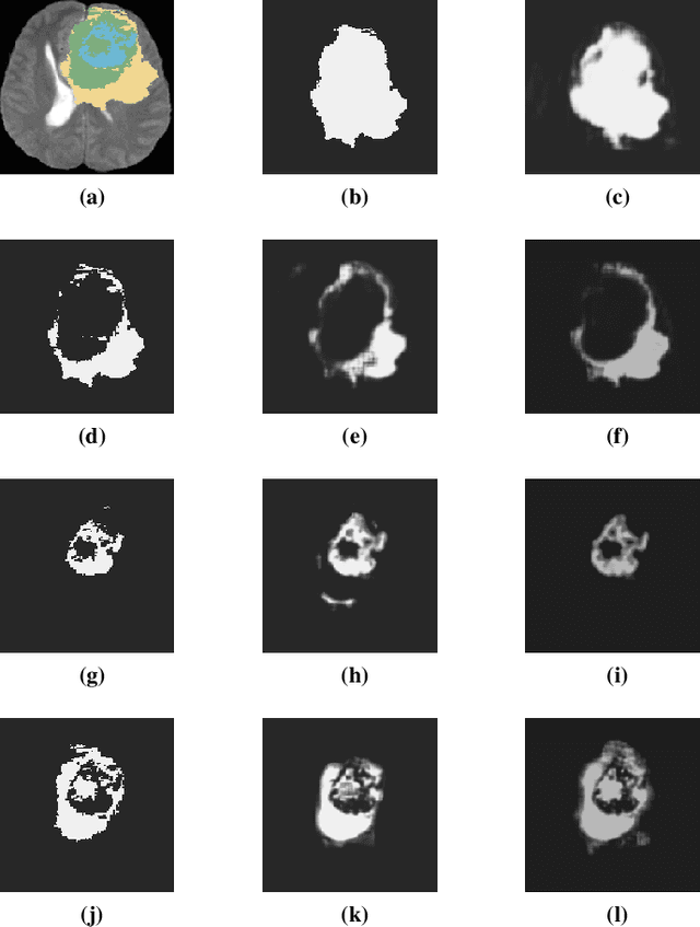 Figure 3 for Prediction of Overall Survival of Brain Tumor Patients