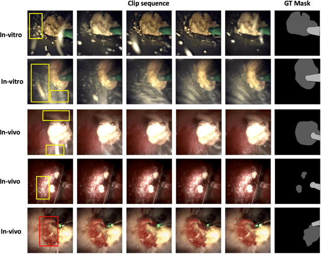 Figure 1 for Multi-class motion-based semantic segmentation for ureteroscopy and laser lithotripsy