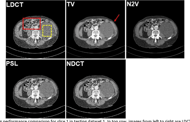 Figure 2 for Probabilistic self-learning framework for Low-dose CT Denoising