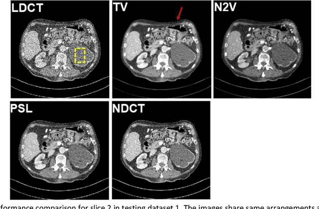 Figure 4 for Probabilistic self-learning framework for Low-dose CT Denoising