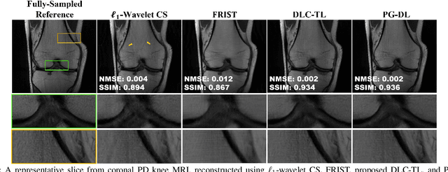 Figure 2 for Accelerated MRI With Deep Linear Convolutional Transform Learning