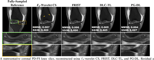 Figure 3 for Accelerated MRI With Deep Linear Convolutional Transform Learning