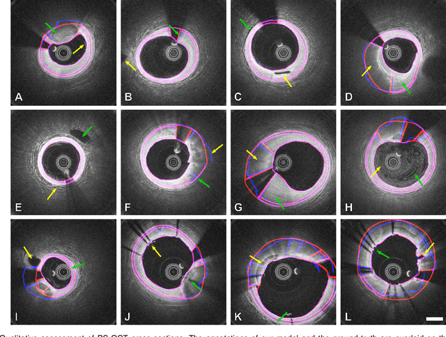 Figure 4 for Segmentation of Anatomical Layers and Artifacts in Intravascular Polarization Sensitive Optical Coherence Tomography Using Attending Physician and Boundary Cardinality Lost Terms