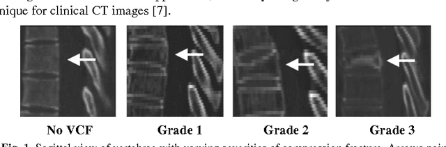 Figure 1 for Multi-Atlas Segmentation with Joint Label Fusion of Osteoporotic Vertebral Compression Fractures on CT