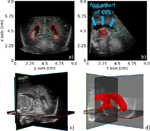 Figure 3 for Automatic Segmentation and Location Learning of Neonatal Cerebral Ventricles in 3D Ultrasound Data Combining CNN and CPPN