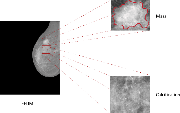Figure 1 for Zoom in to where it matters: a hierarchical graph based model for mammogram analysis