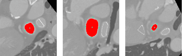 Figure 4 for Automatic Left Atrial Appendage Orifice Detection for Preprocedural Planning of Appendage Closure