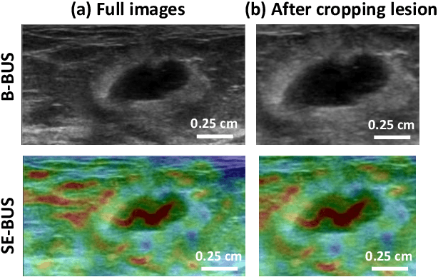 Figure 1 for Ensemble Transfer Learning of Elastography and B-mode Breast Ultrasound Images