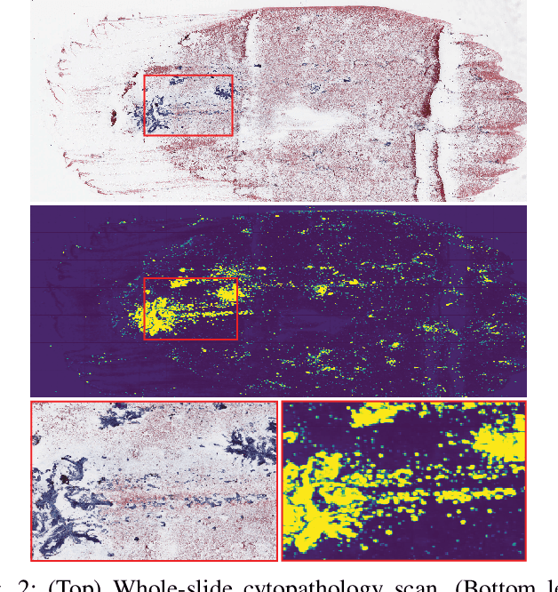 Figure 2 for A Deep-Learning Algorithm for Thyroid Malignancy Prediction From Whole Slide Cytopathology Images