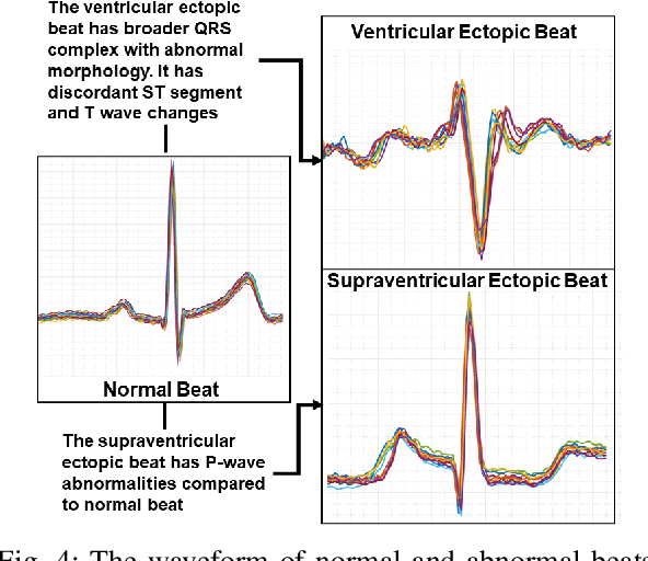 Figure 4 for Energy-Efficient Real-Time Heart Monitoring on Edge-Fog-Cloud Internet-of-Medical-Things