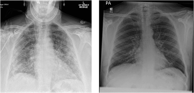 Figure 1 for Optimising Chest X-Rays for Image Analysis by Identifying and Removing Confounding Factors