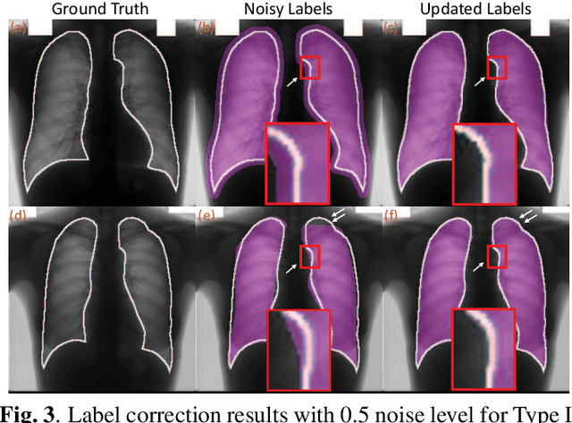 Figure 4 for Co-Seg: An Image Segmentation Framework Against Label Corruption