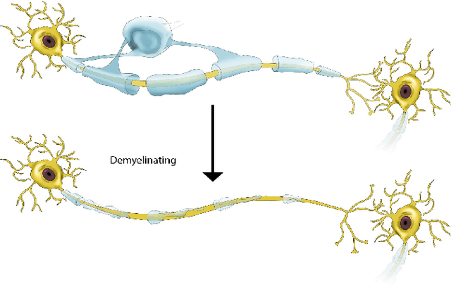 Figure 1 for A Coupled Neural Circuit Design for Guillain-Barre Syndrome