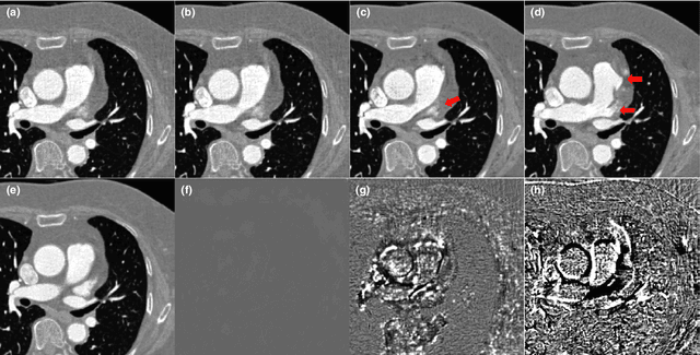 Figure 4 for Cycle Consistent Adversarial Denoising Network for Multiphase Coronary CT Angiography