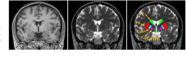 Figure 1 for Joint Progressive and Coarse-to-fine Registration of Brain MRI via Deformation Field Integration and Non-Rigid Feature Fusion
