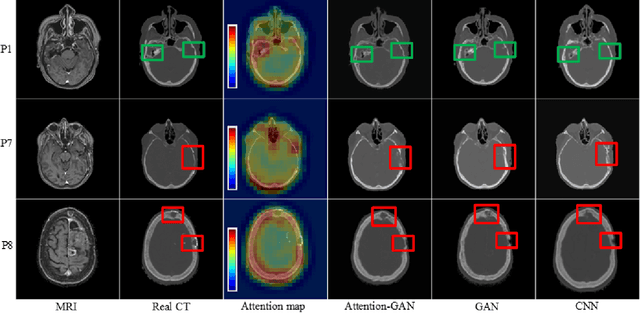 Figure 4 for Attention-Guided Generative Adversarial Network to Address Atypical Anatomy in Modality Transfer