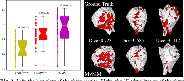 Figure 4 for Atrial fibrosis quantification based on maximum likelihood estimator of multivariate images