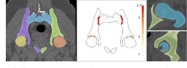 Figure 2 for Auto-segmentation of Hip Joints using MultiPlanar UNet with Transfer learning