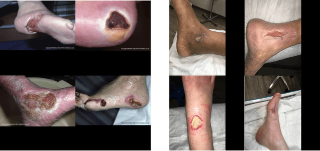 Figure 3 for Automatic Foot Ulcer segmentation Using an Ensemble of Convolutional Neural Networks