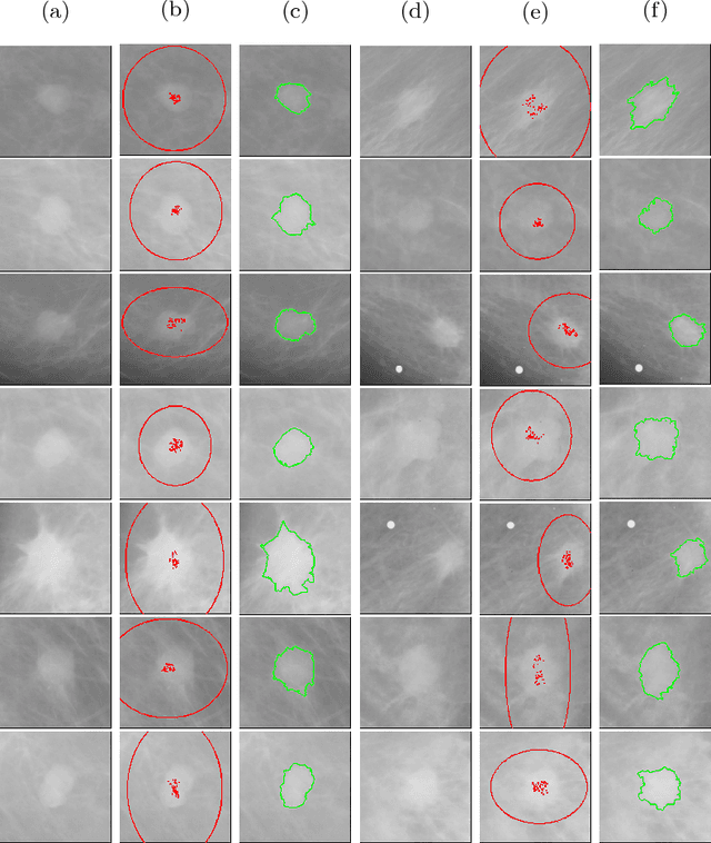Figure 3 for A semi-supervised fuzzy GrowCut algorithm to segment and classify regions of interest of mammographic images