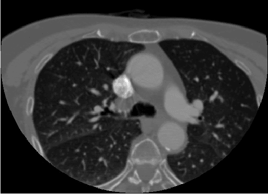Figure 3 for Gradient Based Seeded Region Grow method for CT Angiographic Image Segmentation