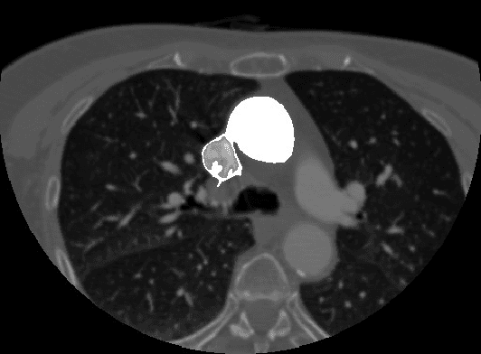 Figure 4 for Gradient Based Seeded Region Grow method for CT Angiographic Image Segmentation