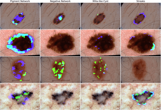 Figure 4 for Fully Convolutional Networks to Detect Clinical Dermoscopic Features