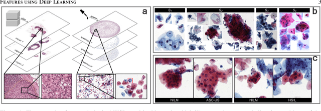 Figure 1 for An Efficient Cervical Whole Slide Image Analysis Framework Based on Multi-scale Semantic and Spatial Deep Features