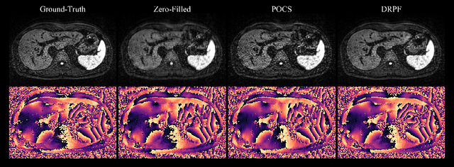 Figure 4 for Robust partial Fourier reconstruction for diffusion-weighted imaging using a recurrent convolutional neural network
