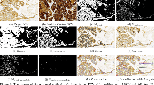 Figure 4 for Automated Scoring System of HER2 in Pathological Images under the Microscope