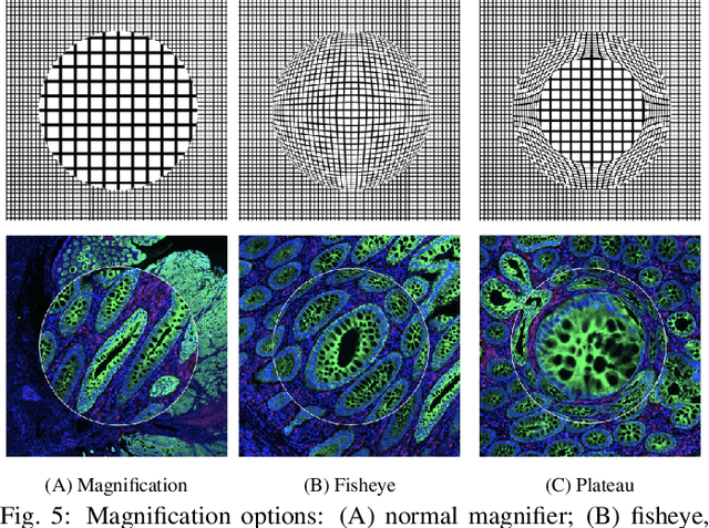 Figure 4 for Scope2Screen: Focus+Context Techniques for Pathology Tumor Assessment in Multivariate Image Data