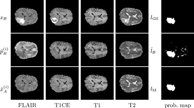 Figure 3 for Pathology Segmentation using Distributional Differences to Images of Healthy Origin
