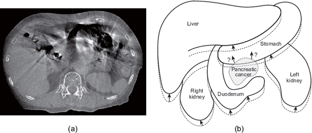Figure 1 for Statistical Deformation Reconstruction Using Multi-organ Shape Features for Pancreatic Cancer Localization