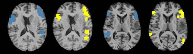 Figure 4 for A Multi-Task Deep Learning Framework to Localize the Eloquent Cortex in Brain Tumor Patients Using Dynamic Functional Connectivity