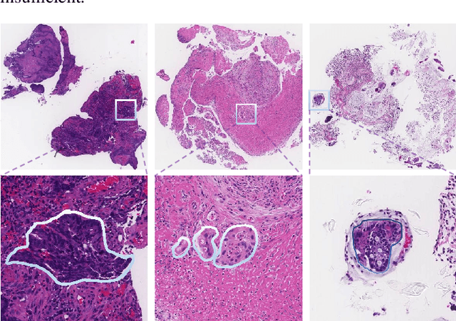 Figure 1 for Multi-level colonoscopy malignant tissue detection with adversarial CAC-UNet