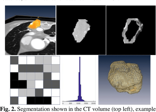 Figure 4 for A deep learning-facilitated radiomics solution for the prediction of lung lesion shrinkage in non-small cell lung cancer trials