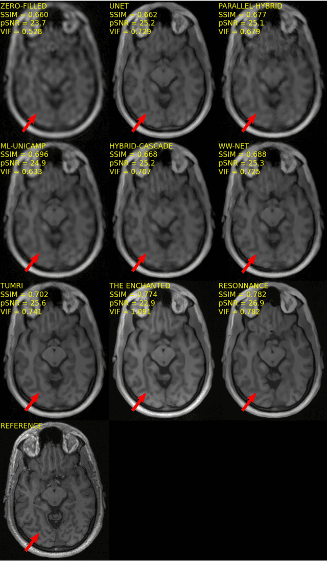 Figure 4 for Multi-channel MR Reconstruction (MC-MRRec) Challenge -- Comparing Accelerated MR Reconstruction Models and Assessing Their Genereralizability to Datasets Collected with Different Coils