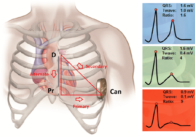 Figure 1 for Deep learning methods for screening patients' S-ICD implantation eligibility
