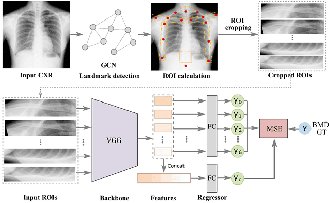 Figure 1 for Opportunistic Screening of Osteoporosis Using Plain Film Chest X-ray