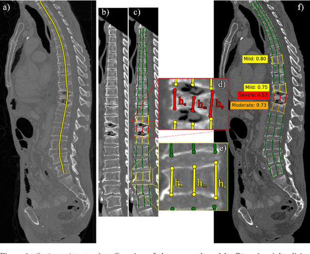 Figure 1 for Interpretable Vertebral Fracture Quantification via Anchor-Free Landmarks Localization