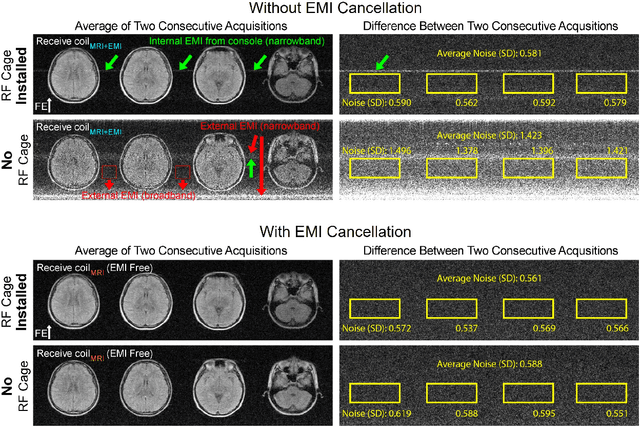Figure 3 for Robust Electromagnetic Interference (EMI) Elimination via Simultaneous Sensing and Deep Learning Prediction for RF Shielding-free MRI